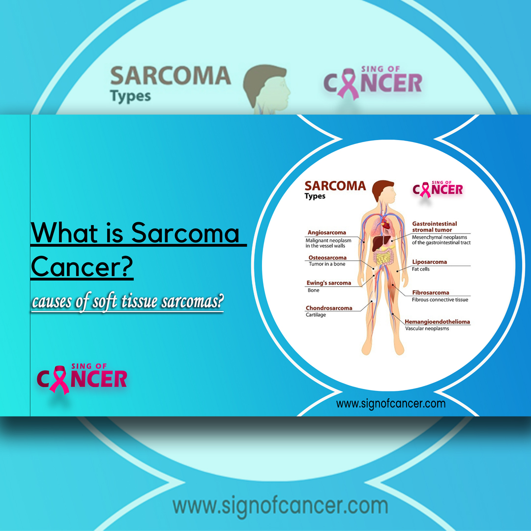  Symptoms of sarcoma Cancer In Human - USA | Sign Of Cancer