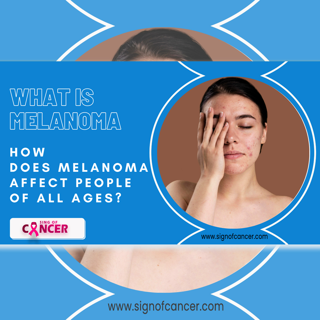 What is Melanoma Cancer - How does Melanoma Affect People of all Ages?